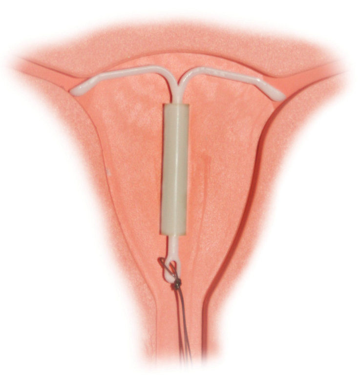 Die Hormonspirale. gemeinfrei
